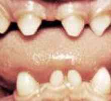 Abnormality zubov formy