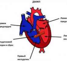 Defekt komorového septa srdca