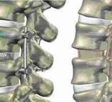 Fixácia chrbtice v spondylolistézou, redukcia medzistavcovej výšky platničky