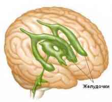 Mozog hydrocefalus u dospelých