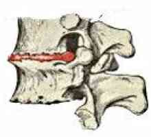 Osteochondrosis