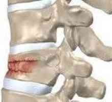 Hrudnej chrbtice zlomenina