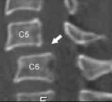 Subluxácia krčnej chrbtice