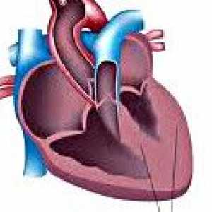 Sekundárne kardiomyopatia